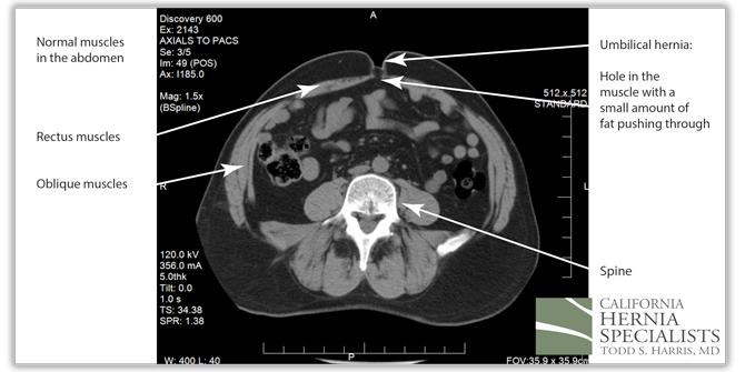 CT Image of Umbilical Hernia